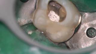 Resorption Nonsurgical Treatment of a Molar with complete narrative [upl. by Colwin217]