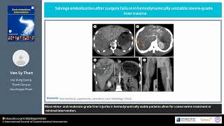 Salvage embolization after surgery failure in hemodynamically unstable severegrade liver trauma [upl. by Siravat853]