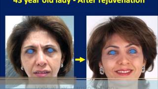 Botox amp Dermal Filler Injection Made Her Young Again  Liquid Facelift Technique [upl. by Llednar234]