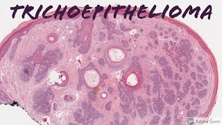 Trichoepithelioma 101 [upl. by Airec]