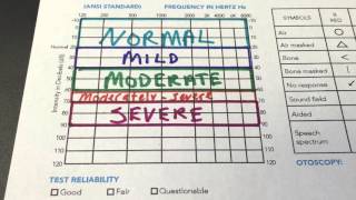 How to Read Your Audiogram [upl. by Candice]