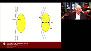 Management of Acute Angle Closure Glaucoma [upl. by Ahcim]