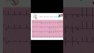 Identificación y Tratamiento de Taquiarritmias Flúter Taquicardia Atrial y Fibrilación Auricular [upl. by Aniham381]