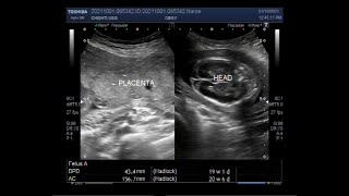 Fetal anomalies Dilated ventricles Missing limbs Oligohydramnios and Missing fetal movements [upl. by Ylas691]