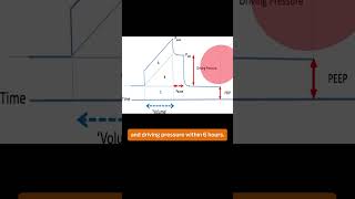 Time Standardised Management of ARDS [upl. by Drarig718]