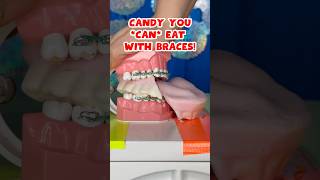 3 BEST and WORST HALLOWEEN CANDY for BRACES  TEETH 🎃👻🦷 braces candy crunchy [upl. by Aronal]