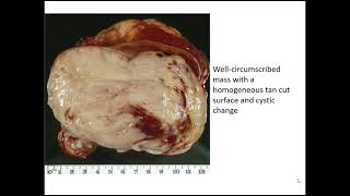 Renal Tumors Case 9 [upl. by Euqinomad293]