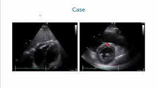 An Athletes Battle with Constrictive Pericarditis [upl. by Eimmit391]