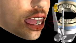 Dental Articulator in Dentistry [upl. by Aelrac979]