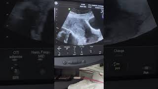 Two different cases of Endometrial Hyperplasia diagnostic ultrasound cases [upl. by Inor]