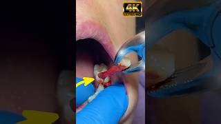 How can a simple abcessed turn into root canal or tooth loss toothextraction rootcanaltreatment [upl. by Drabeck]