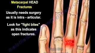 Metacarpal Fractures  Everything You Need To Know  Dr Nabil Ebraheim [upl. by Lednek355]