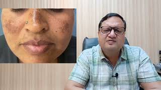 Pigmentation Treatment Price  Laser Pigmentation Treatment  Causes  Kayakalp Laser Clinic [upl. by Ettenuj]