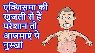 Home Remedies for Eczema  एक्‍जिमा की खुजली  आजमाएं ये नुस्‍खा eczema eczemacure health [upl. by Nohtiek660]