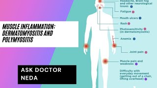 Muscle Inflammatory Disease DermatomyositisPolymyositis Diagnosis and Treatment [upl. by Sirrot250]