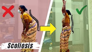 Amazing Recovery Scoliosis Chiropractic Treatment  Dr Sanjay Sarkar USA  Call 9903026262 [upl. by Cook656]