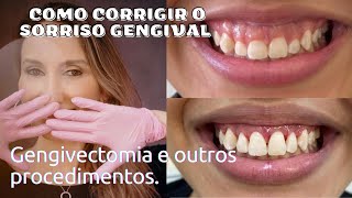 Tratamento para o Sorriso Gengival Gengivectomia Gengivoplastia Aumento de Coroa Clínica Botox [upl. by Bjorn]