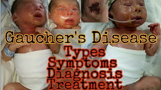 Gaucher Disease  Types symptoms diagnosis treatment  MisMedicine [upl. by Terrene219]