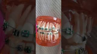 Braces Time Lapse 2 years 8 months⎥4 Premolars Extracted Bimaxillary Protrusion Side Profile [upl. by Aimal244]