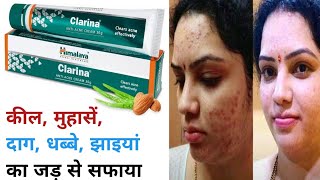 Himalaya Clarina Antiacne Cream Review  Kaise use kare  Results  Acne Removal Cream [upl. by Jeramey]