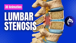 Lumbar Stenosis  3D Animation [upl. by Nahtad]