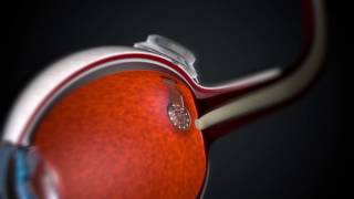 Graphenebased retina prosthesis [upl. by Aidekal471]