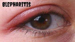 blepharitis treatment at home  5 Home Remedies For Blepharitis  clickbank review [upl. by Ennaillij]