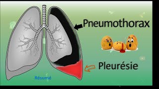 💨 Pneumothorax 🆚 Pleurésie 💧  Résumé  PneumoPhtisiologie [upl. by Hgielime]