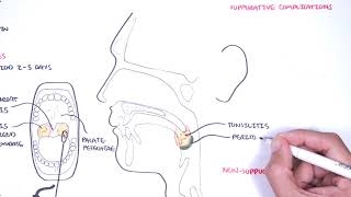 Strep throat streptococcal pharyngitis pathophysciology signs and symptoms diagnosis treatment [upl. by Adelbert458]