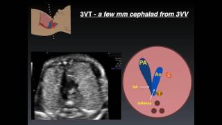 Three Vessel Tracheal View A Review of Normal and Abnormal Findings [upl. by Nnave958]