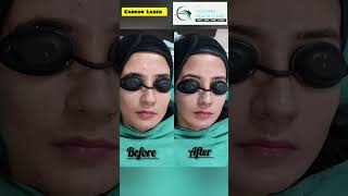 ✨ Carbon Laser Facial The Ultimate Skin Glow Treatment [upl. by Rutledge337]