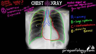 LEARN to Read a Chest Xray in 5 minutes [upl. by Chaudoin]