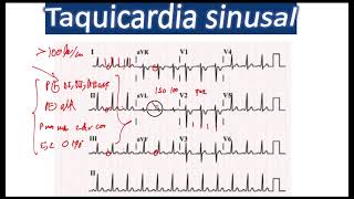 Taquicardia y Bradicardia Sinusal EKG [upl. by Narine304]