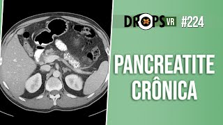 PANCREATITE CRÔNICA ACHADOS DE IMAGEM E CLÍNICA [upl. by Reinhold]