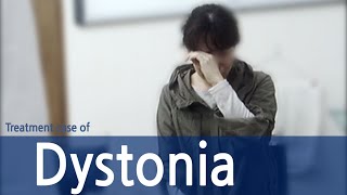 Generalized spasmodic dystonia  Spasmodic Torticollis  Dystonia  사경증 치료사례  근긴장이상증 [upl. by Mosenthal]