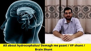 VP Shunt brain shunt brain surgery hydrocephalus water in the brain Dr Yousuf Shaikh [upl. by Darrey596]