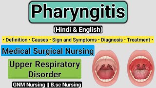 Pharyngitis Definition Causes Signs and symptoms Diagnosis Treatment  Pharyngitis In Hindi [upl. by Yehs]