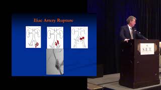 Endovascular Treatment of IliofemoralSFA Occlusion [upl. by Tahp]