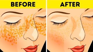 How to Get Rid of Acne Scars In Just 3 Days [upl. by Milurd]