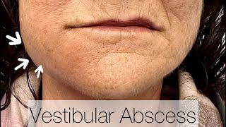 Vestibular Abscess Drainage [upl. by Itraa]