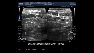 Ultrasound Video showing multiple enlarged lymph nodes ie Lymphadenopathy [upl. by Sedrul]