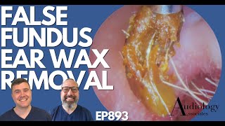 FALSE FUNDUS EAR WAX REMOVAL  EP893 [upl. by Ahsilef]