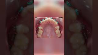 Braces Changes Timelapse of the Upper teeth with Extractions  TheBracesDoc [upl. by Killian]