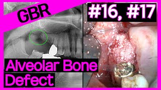 Online Surgery 16 amp 17 Implant using OneGuide after flap elevation for GBRAOssOssGuide [upl. by Acinnej111]