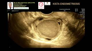 Endometriosis Cyst [upl. by Lomasi]