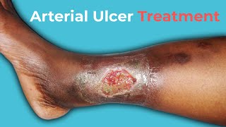 What Are Arterial Ulcers Arterial Ulcer Treatment [upl. by Maxfield612]