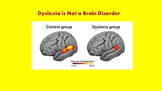 Dyslexia Some Background Information Andrew P Johnson PhD [upl. by Harmon]