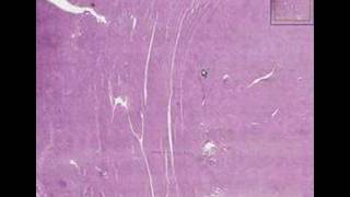 Histopathology UterusLeiomyoma [upl. by Yanetruoc]