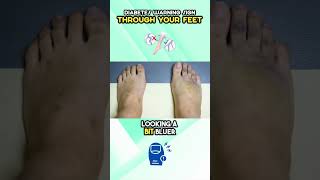 Diabetes Warning Sign through your Feet [upl. by Inman]