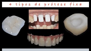 Prótese Fixa  4 tipos diferentes [upl. by Ahsekram]